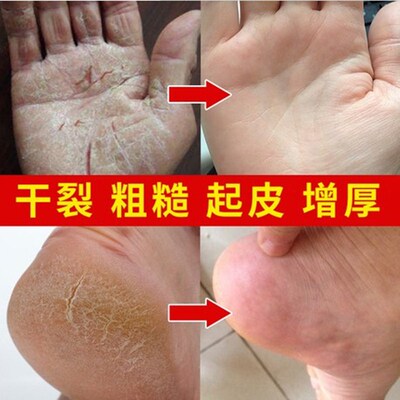 手足防干裂足霜脚后跟膏保湿嫩足润足龟Q裂秋冬脱皮去死皮