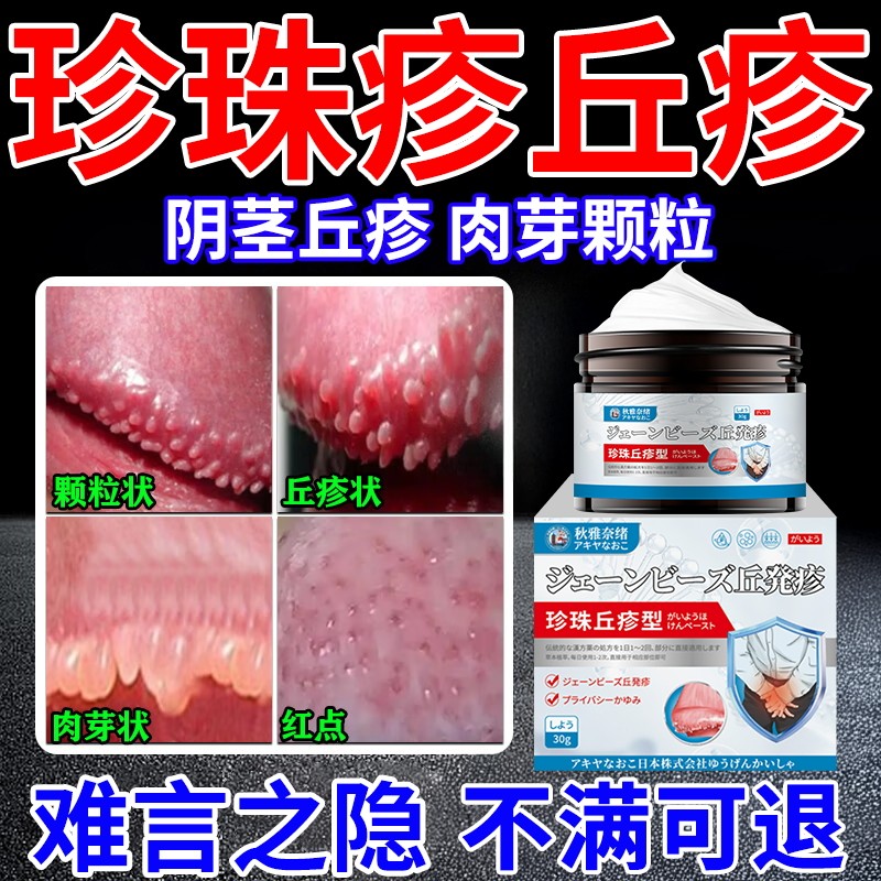 珍珠丘疹膏龟头炎包皮炎阴茎冠状沟珍珠粒疹去除小疙瘩真菌感染膏
