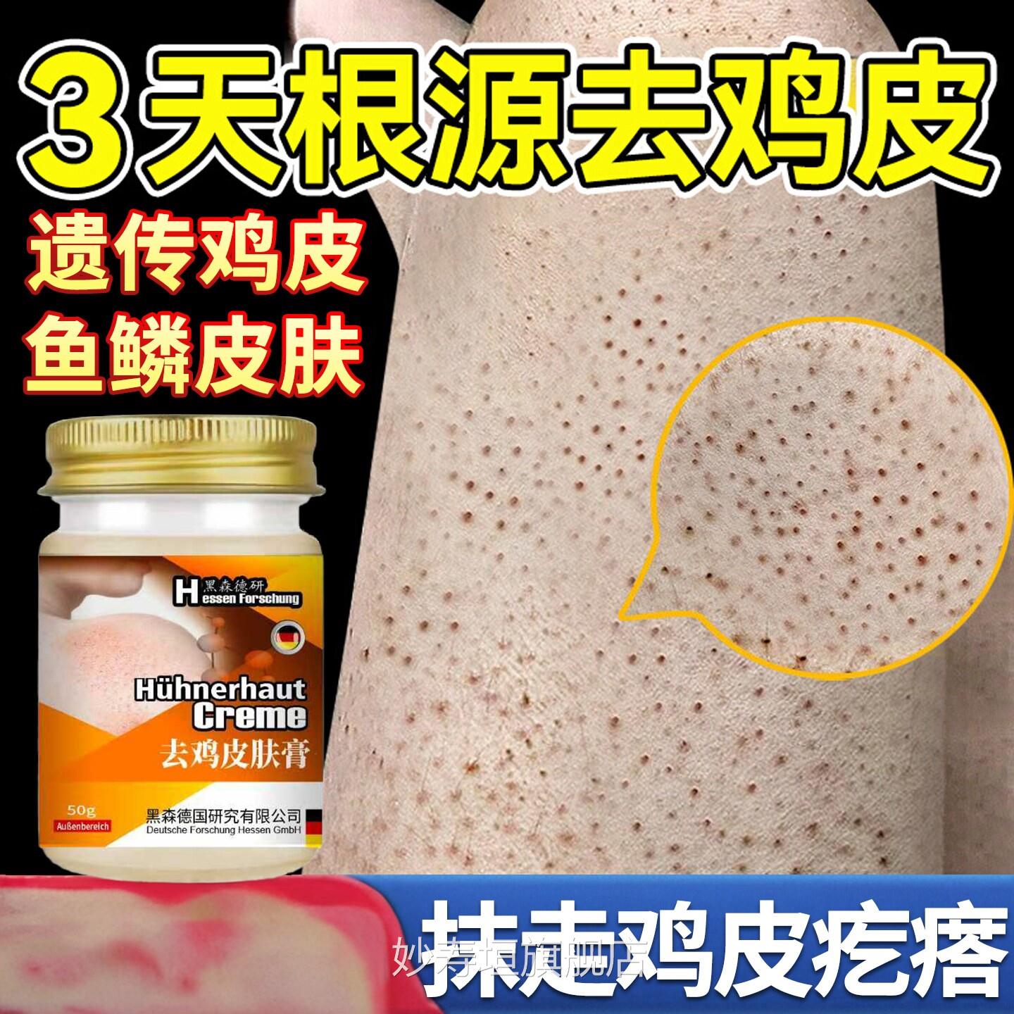 日本鸡皮肤瘩毛囊角化疙症用膏去除全身手臂胳膊腿干燥起皮神器妙