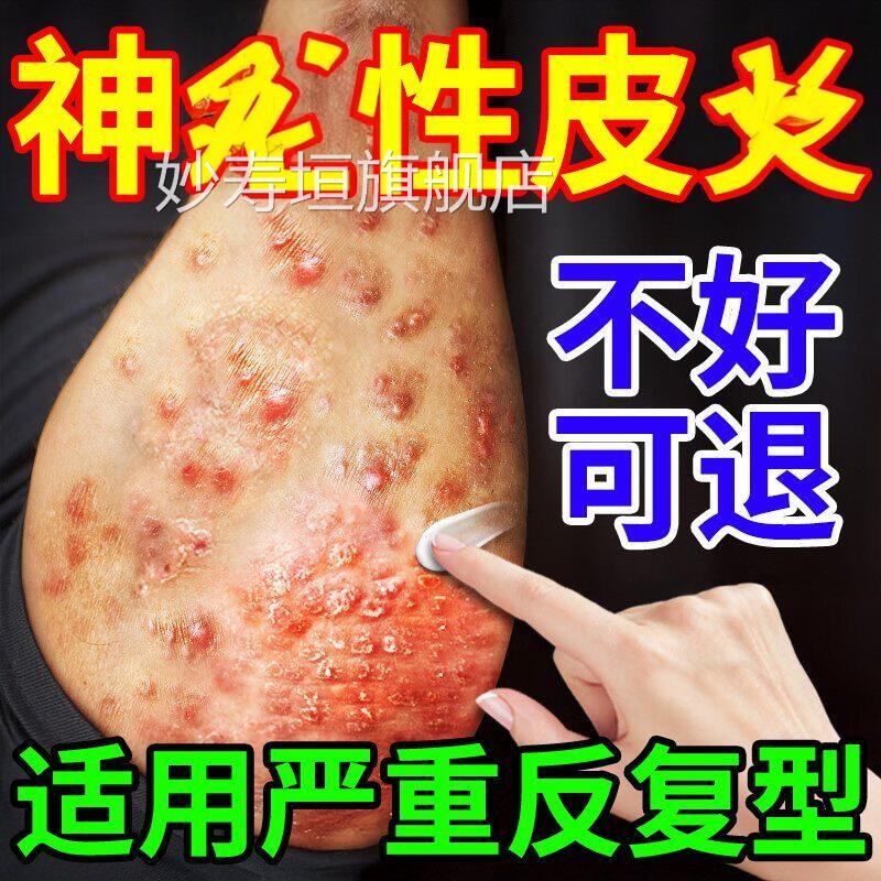 皮肤鲜痒日本进疗神经性口皮顽固反复湿瘙外用膏药病皮疹克星治妙