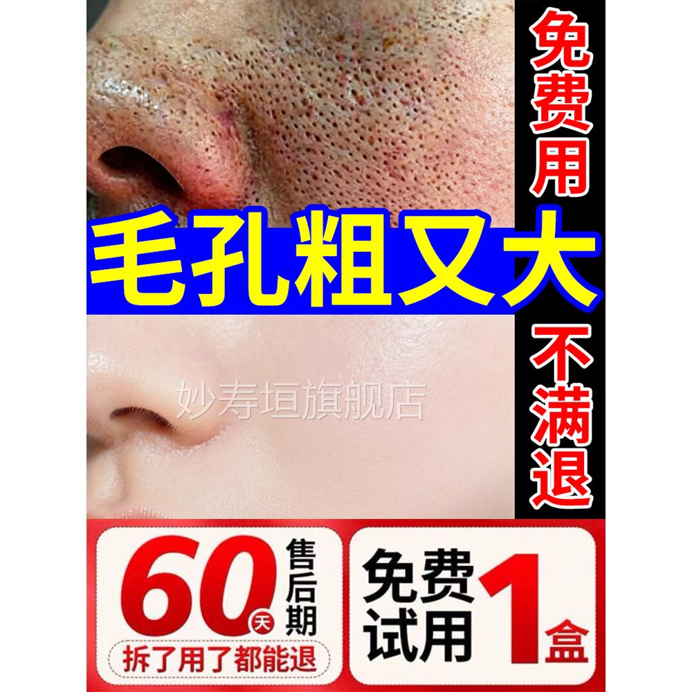 去黑头收缩毛孔粗大收坑缩修复医用型粉刺闭口男生淡化痘印痘果酸