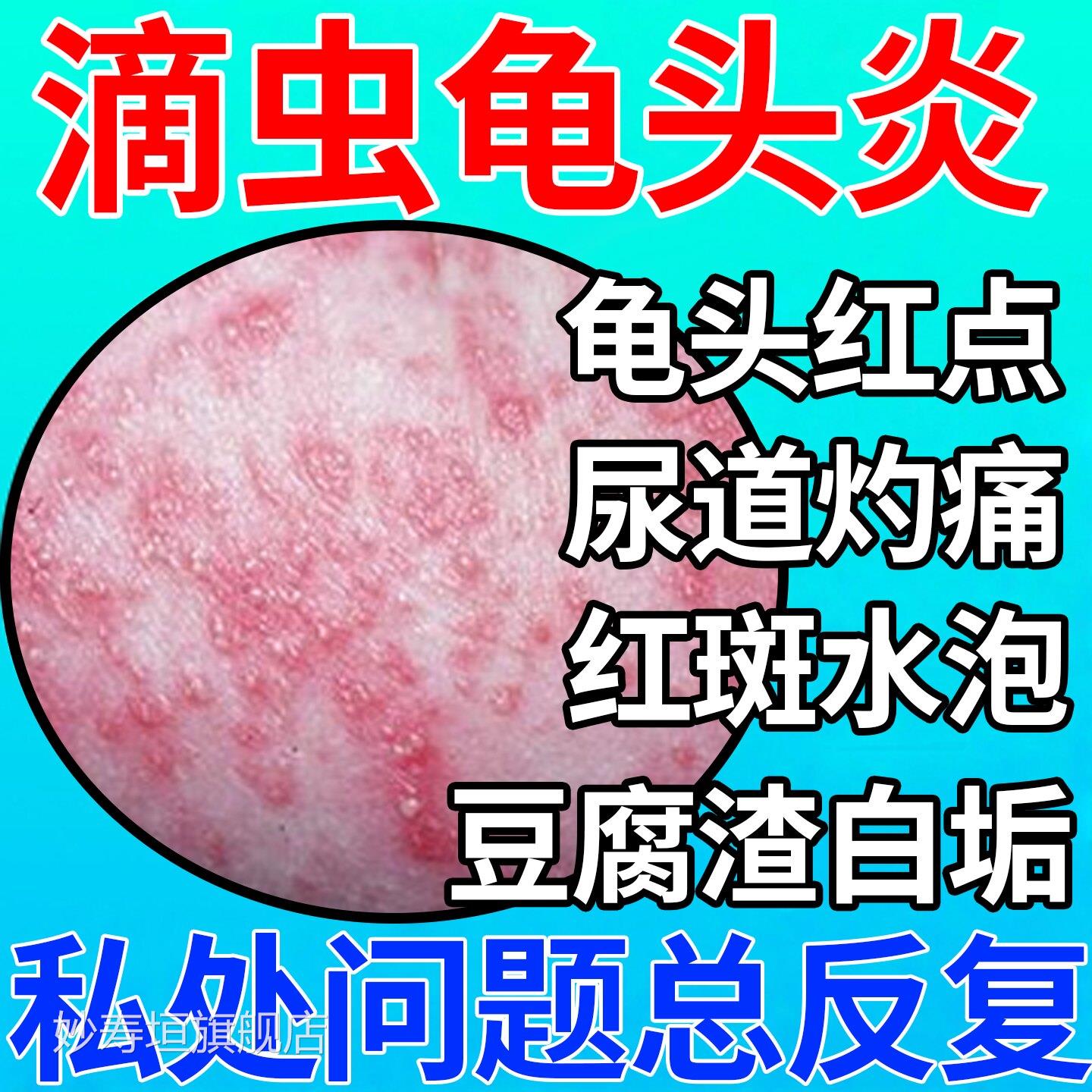 滴虫性龟头炎症龟头小红点尿道灼疼面痛红斑水泡包皮下豆腐渣白垢