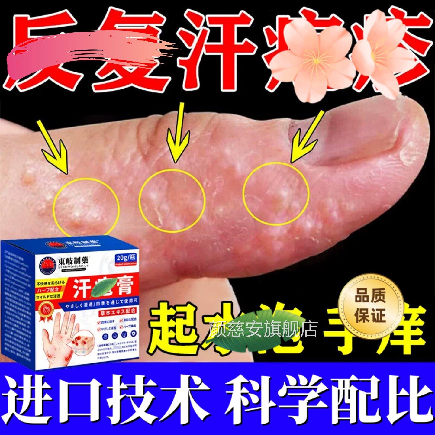 手上起小水泡汗状疱痒疹带真杀菌感染止湿手气脱皮痒状专去疹用膏