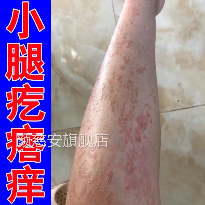 夏天汗小腿痒成人止膏出身上痒天热皮肤疹痒瘙热疙瘩红疹热毒痒颜