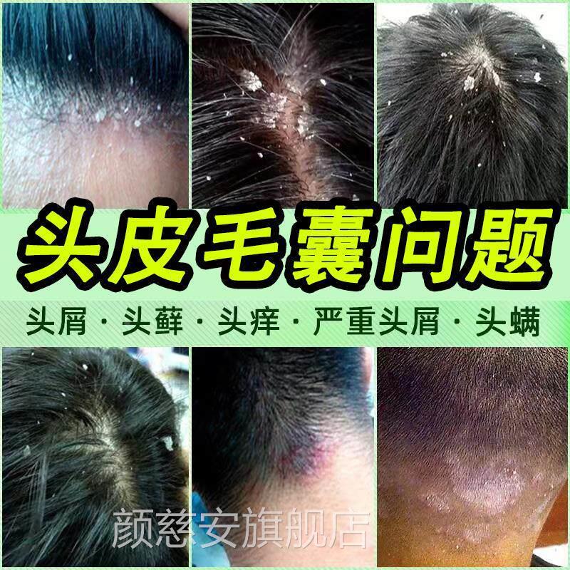 头部头皮痘屑癣头上长痘结痂可搭毛囊炎洗发水专用搭药膏中药克星