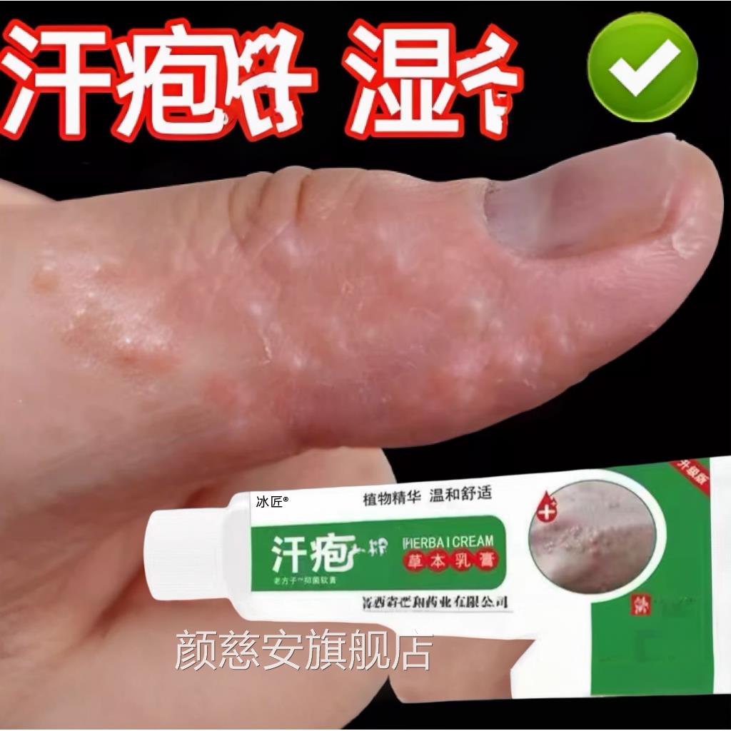 汗疱去手上起小水汉汗状真菌感染用软膏干裂泡脱皮痒根颜慈安旗舰
