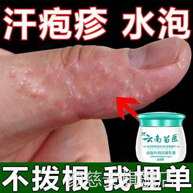 手足脱皮汗疹疱手藓真菌感染干裂水泡湿止痒去疹汗疹疱根膏乳膏颜