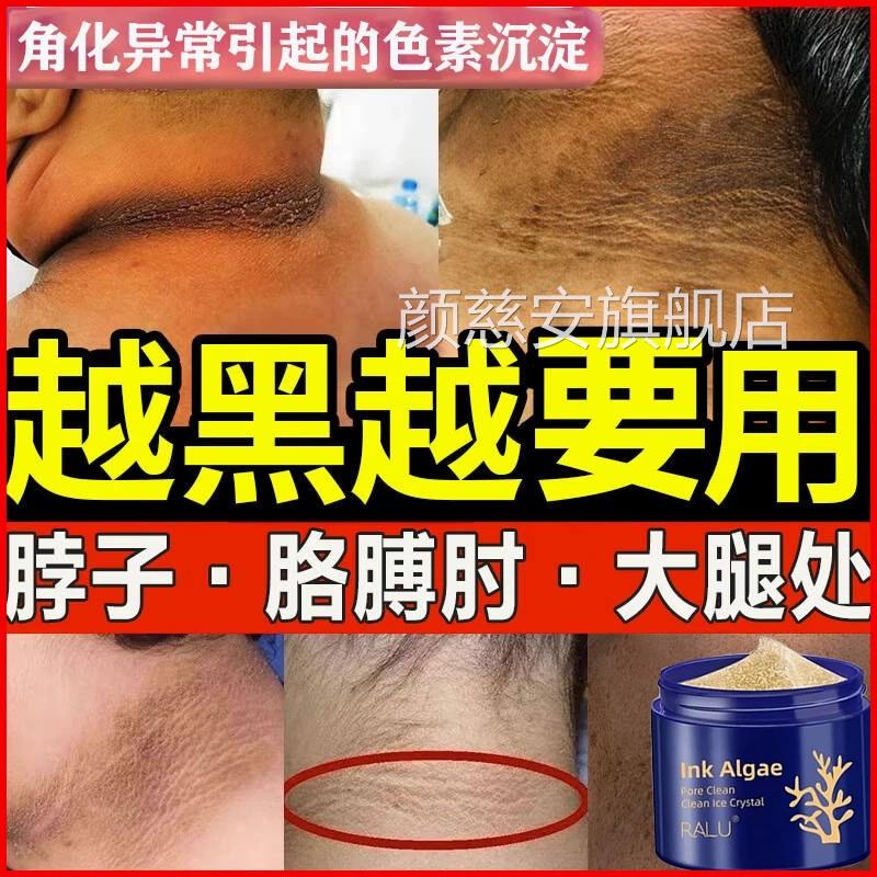 去脖子色素去除黑棘皮后黑脖子去除颈部黑色素沉淀洗不干净清洁膏