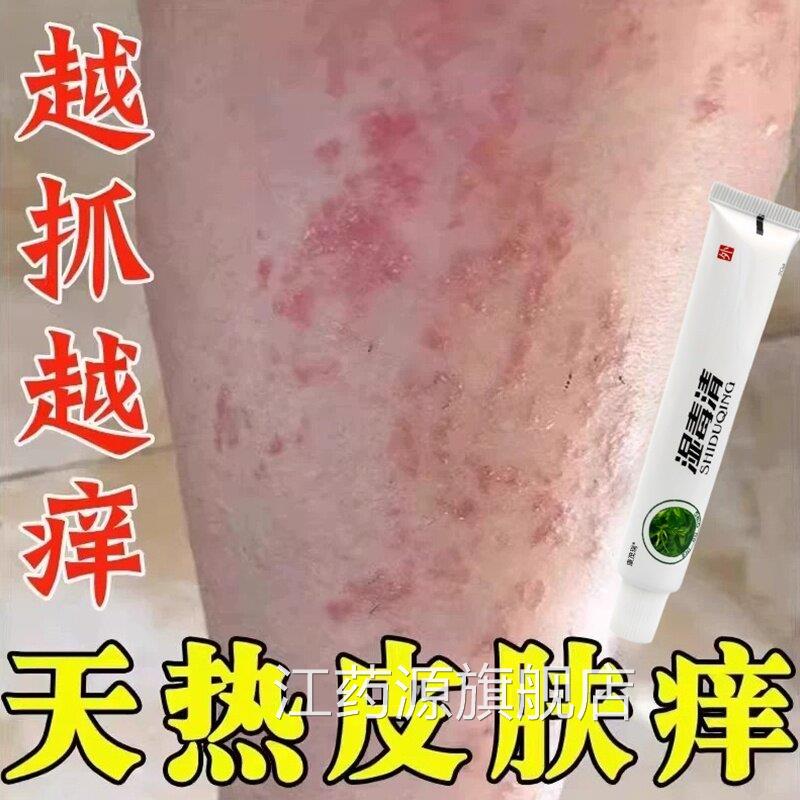 夏天小腿痒湿成人止痒膏出汗身上痒天热皮肤疹痒热疙瘩红热毒江药