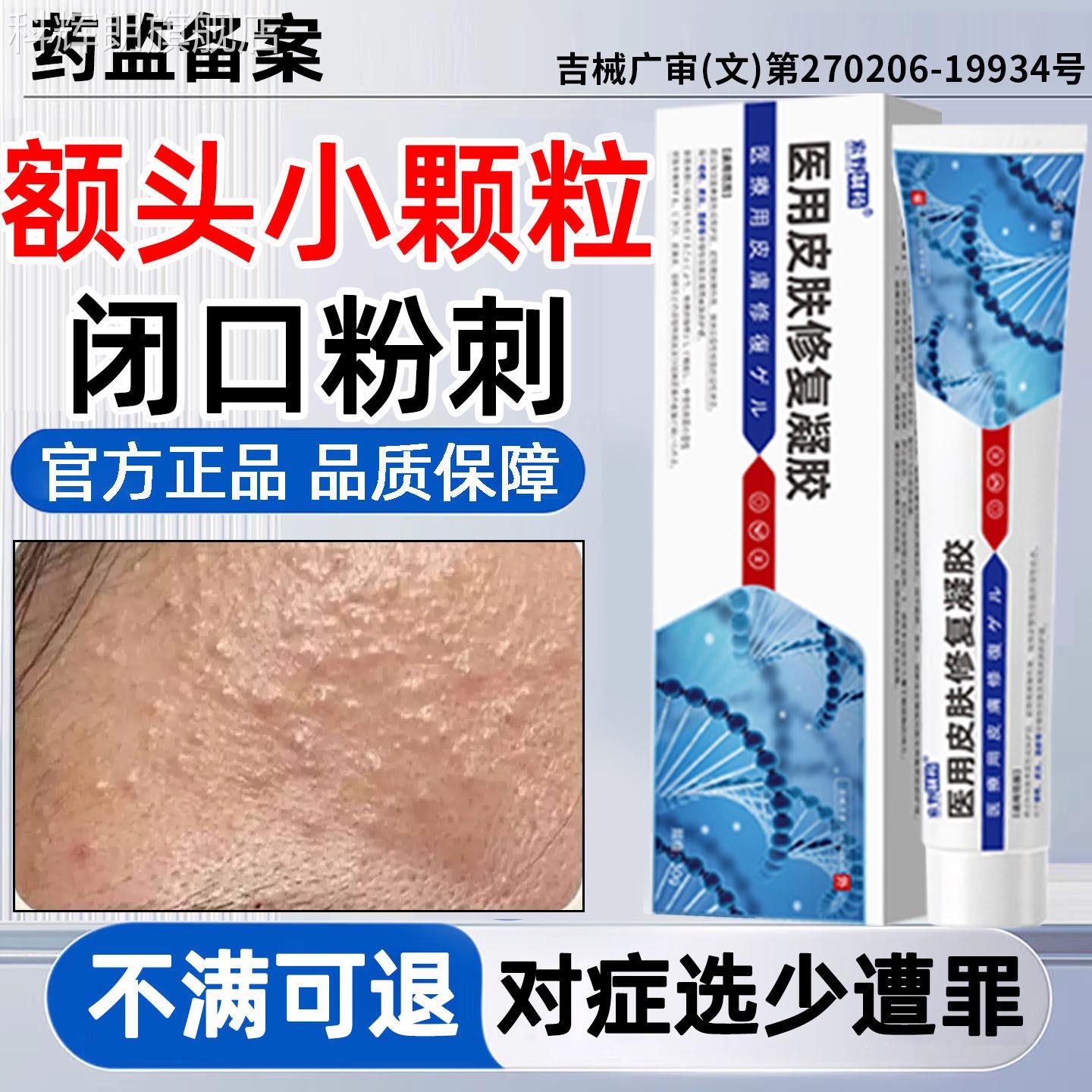 闭口粉刺小颗粒脸面起部逆光疹儿童脸上小疙瘩屏障受损毛囊堵塞QQ