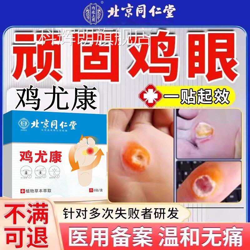 北京康同仁堂鸡眼膏去医用级鸡尤贴脚专用水杨酸顽固手部除科辉朗