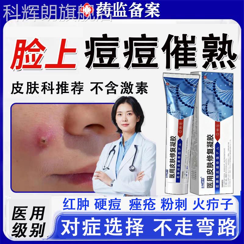 脸上红肿结节硬块痘痘催熟药下巴反复膏长痘痤疮膏火疖肿拔毒脓TK