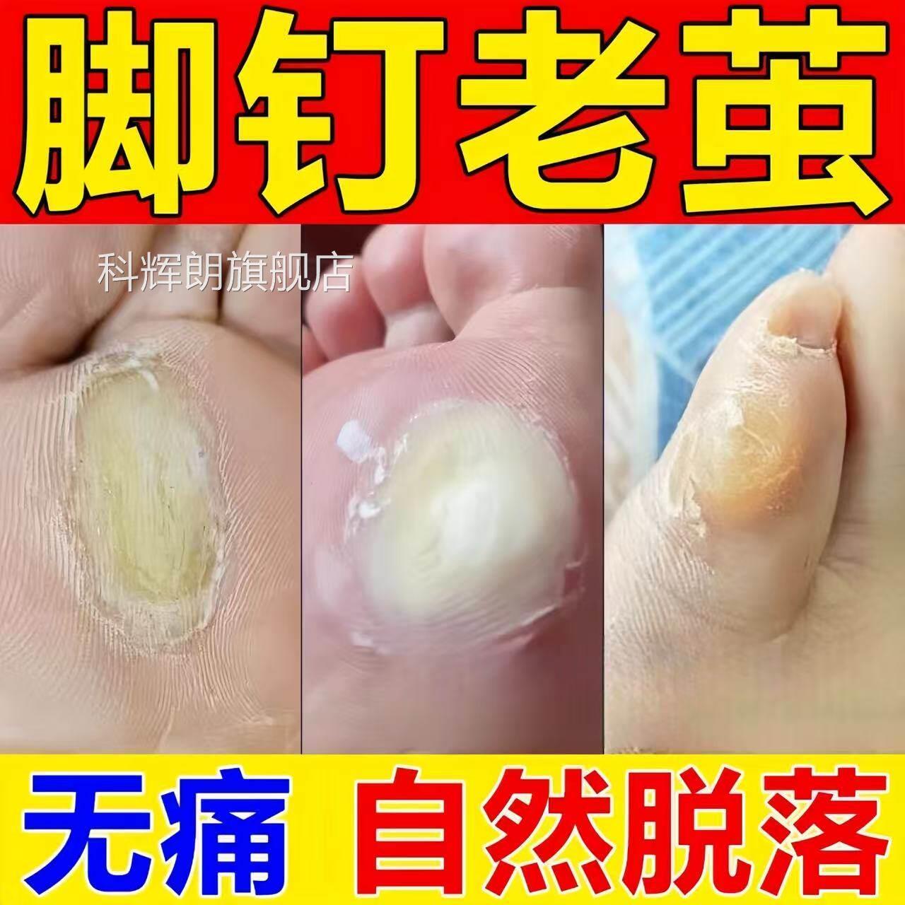 脚钉除膏去除厚脚垫老茧死皮根去脚底祛板脚掌趾指头硬皮软化剂科