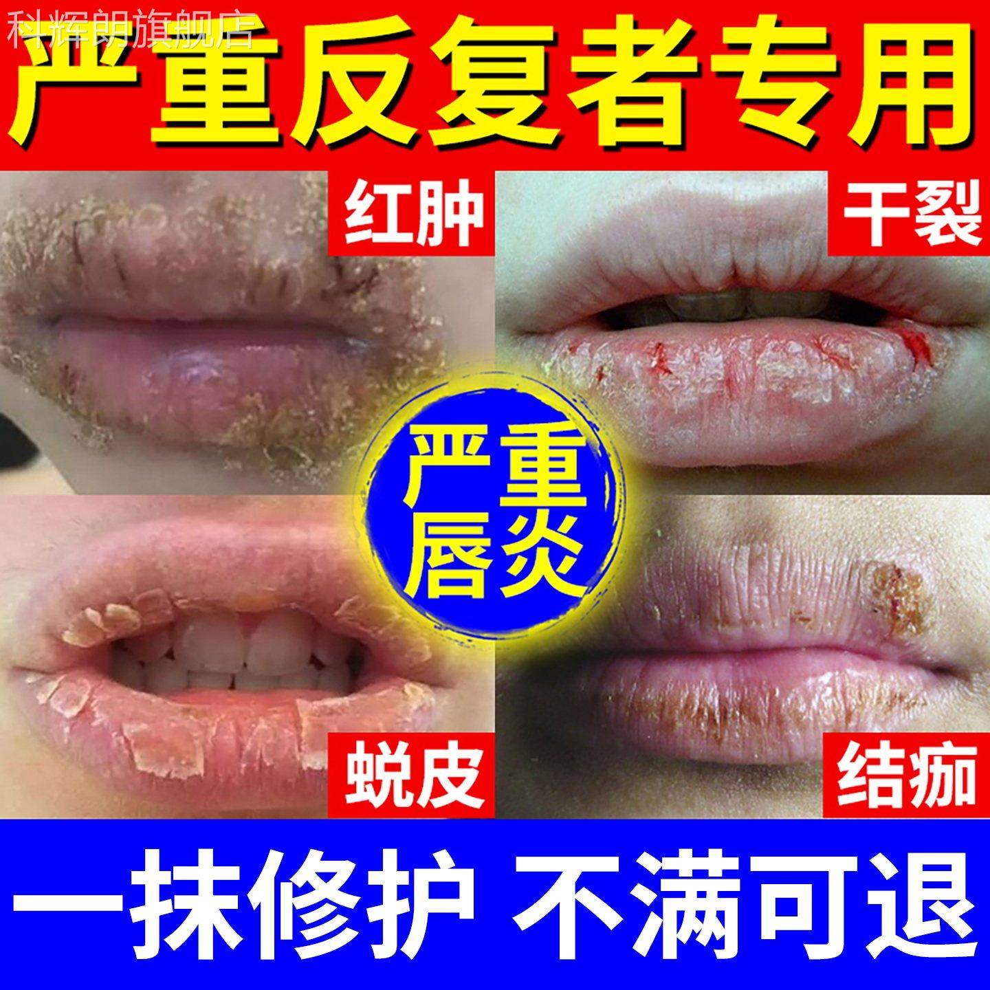 唇炎用唇膏干裂脱皮口角炎疱疹修护润嘴唇去死皮淡化唇纹专医用型