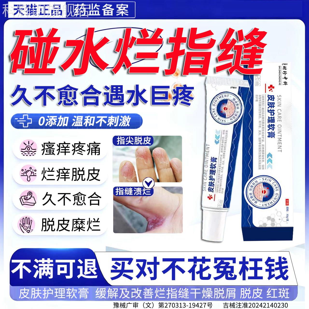 手指溃缝烂洗碗烂手手癣膏脱皮干裂真菌感染水泡手气瘙痒疼痛A科