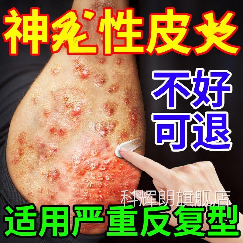皮肤痒日本进口疗神经性皮顽固反复湿瘙外用膏药鲜病皮疹克星治科