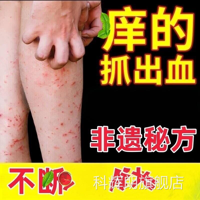 皮肤干燥痒老年人湿疹止痒去外根用顽固皮炎腿皮瘙肤干燥止抑痒菌