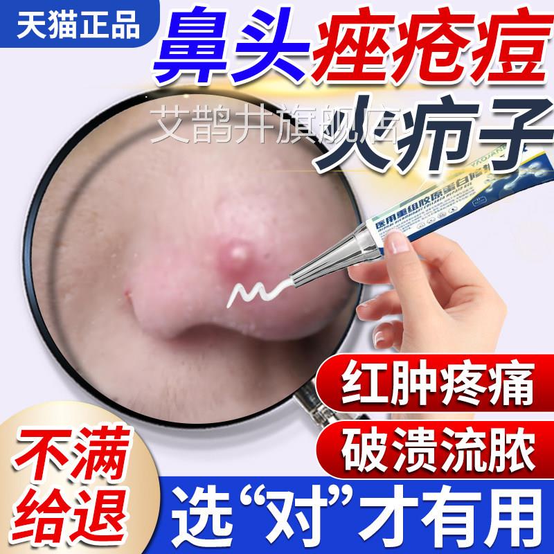 鼻子红肿痘长痘痘鼻头鼻尖火疖子毛囊炎上肉疙瘩脓包囊痤疮肿u9艾