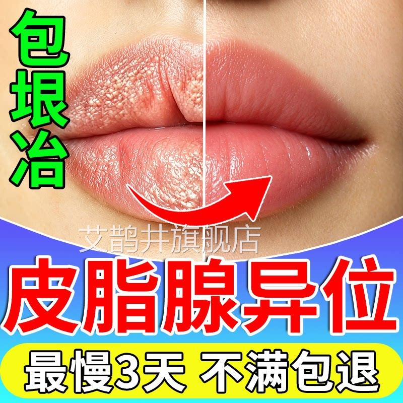 皮脂腺异位症嘴唇白点脱皮去除面部私处疱脂肪小颗粒疹增生膏神器
