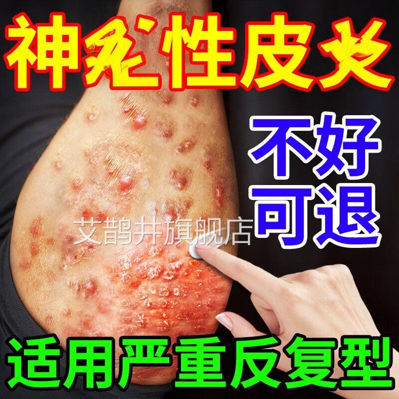 神皮肤鲜痒日本进口疗经性皮顽固反复湿瘙外用膏药病皮疹克星治艾
