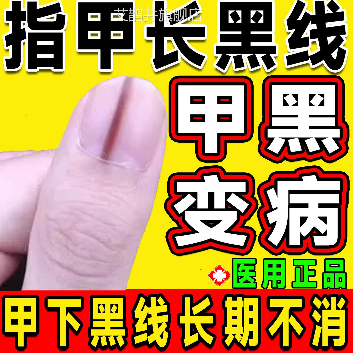 甲母痣黑线指甲儿童指甲营养液变纹黑发紫淤血修复竖灰指甲专用LT