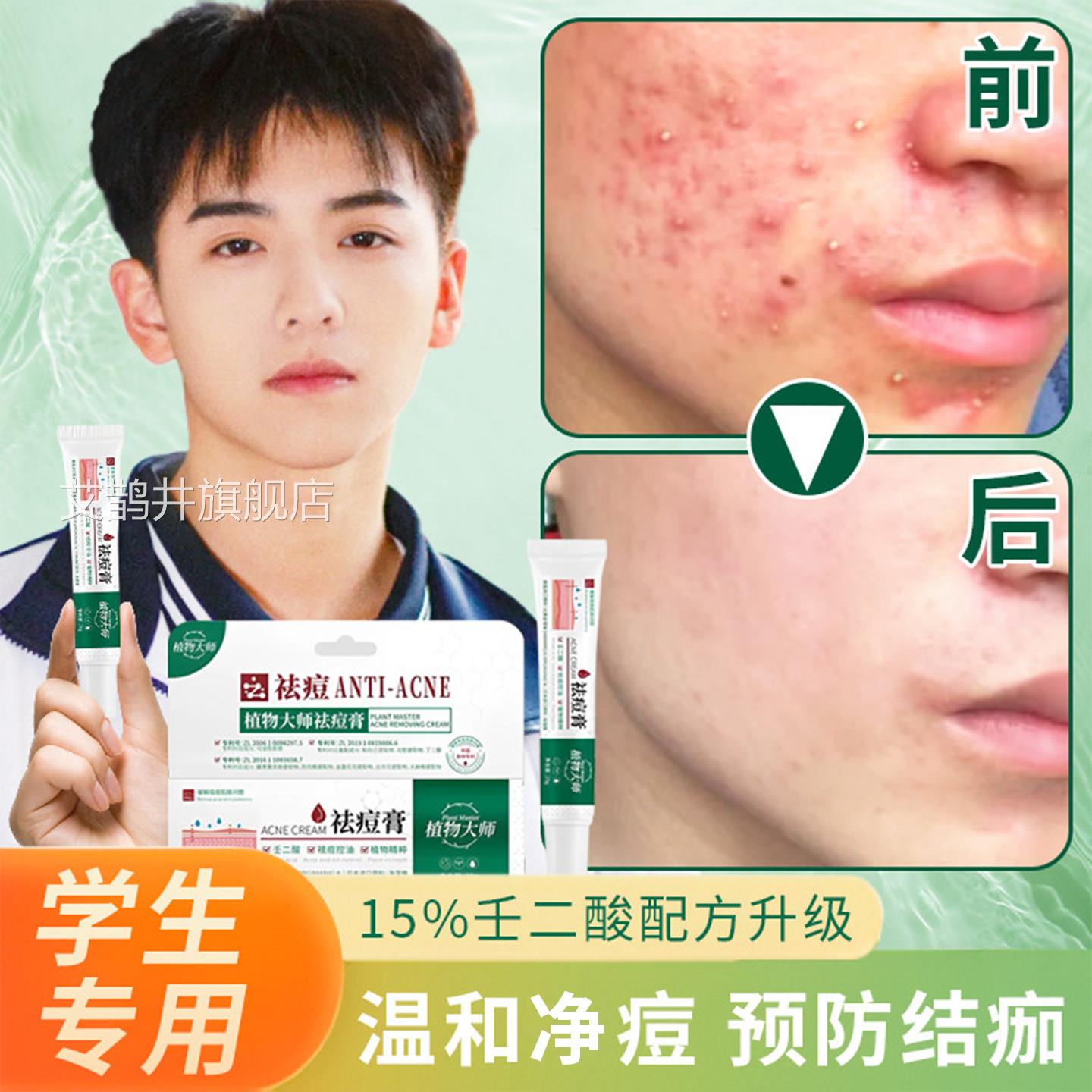 青少年脸痘膏痘去祛正品青春痘初中生女额头痤疮治上痘痘的药膏艾