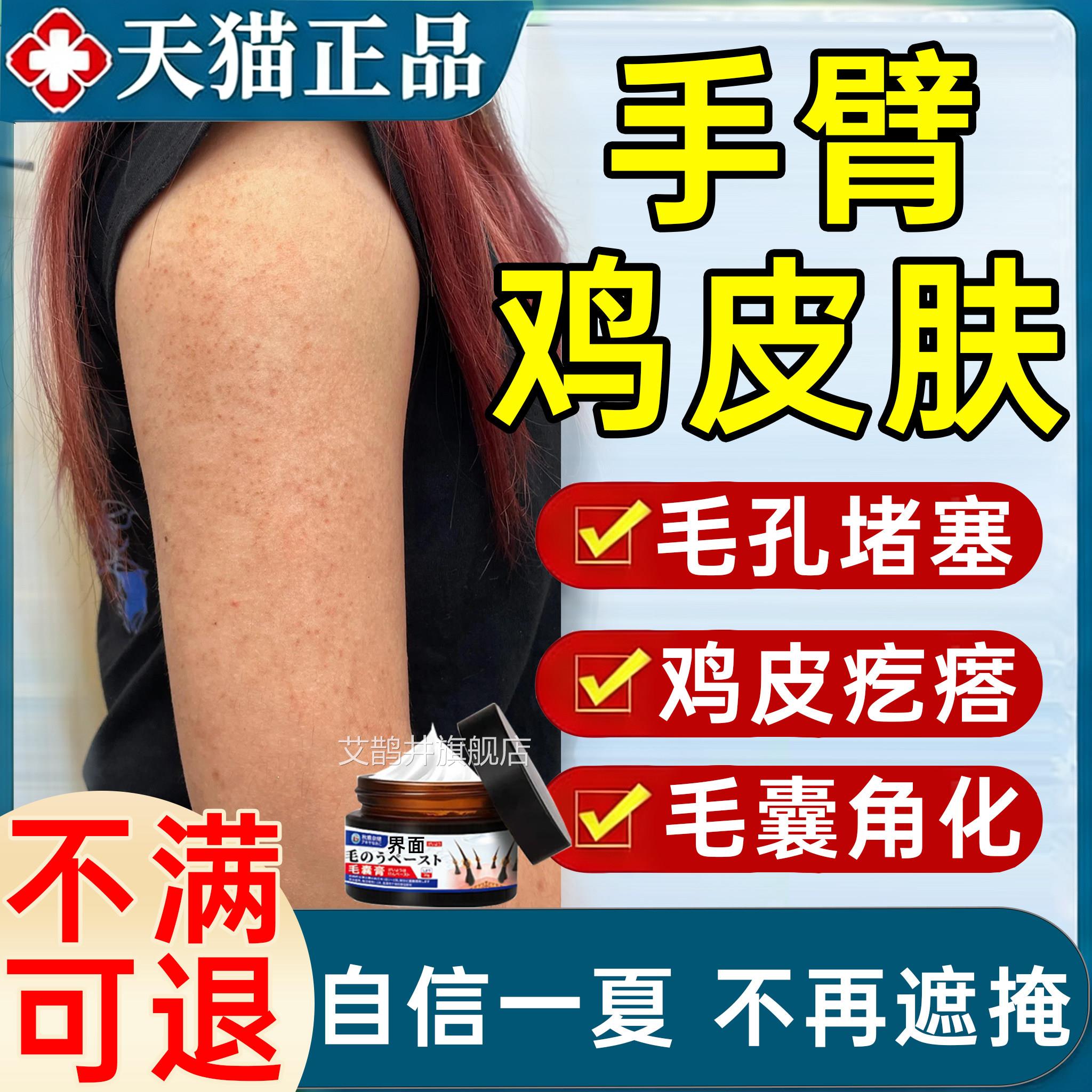 手臂鸡皮肤疙瘩毛囊角化药膏去除全身手臂上长疙瘩毛囊腿炎除螨艾