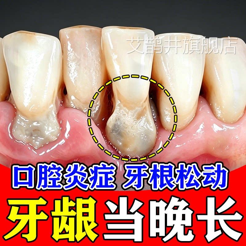 牙萎缩修复再生专用固牙齿膏松动缝大肿痛医用口腔牙龈周炎洁离剂