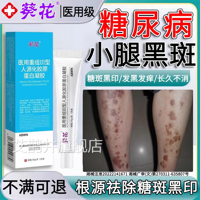 去除糖斑糖尿病引起腿黑斑专胫前皮肤色素沉着发痒用黑印烂小足膏