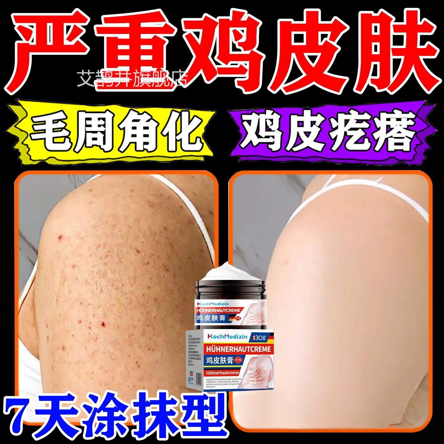 鸡皮肤疙瘩毛囊角化症专除神器全囊身手臂鸡皮大腿部毛炎痘痘艾鹊