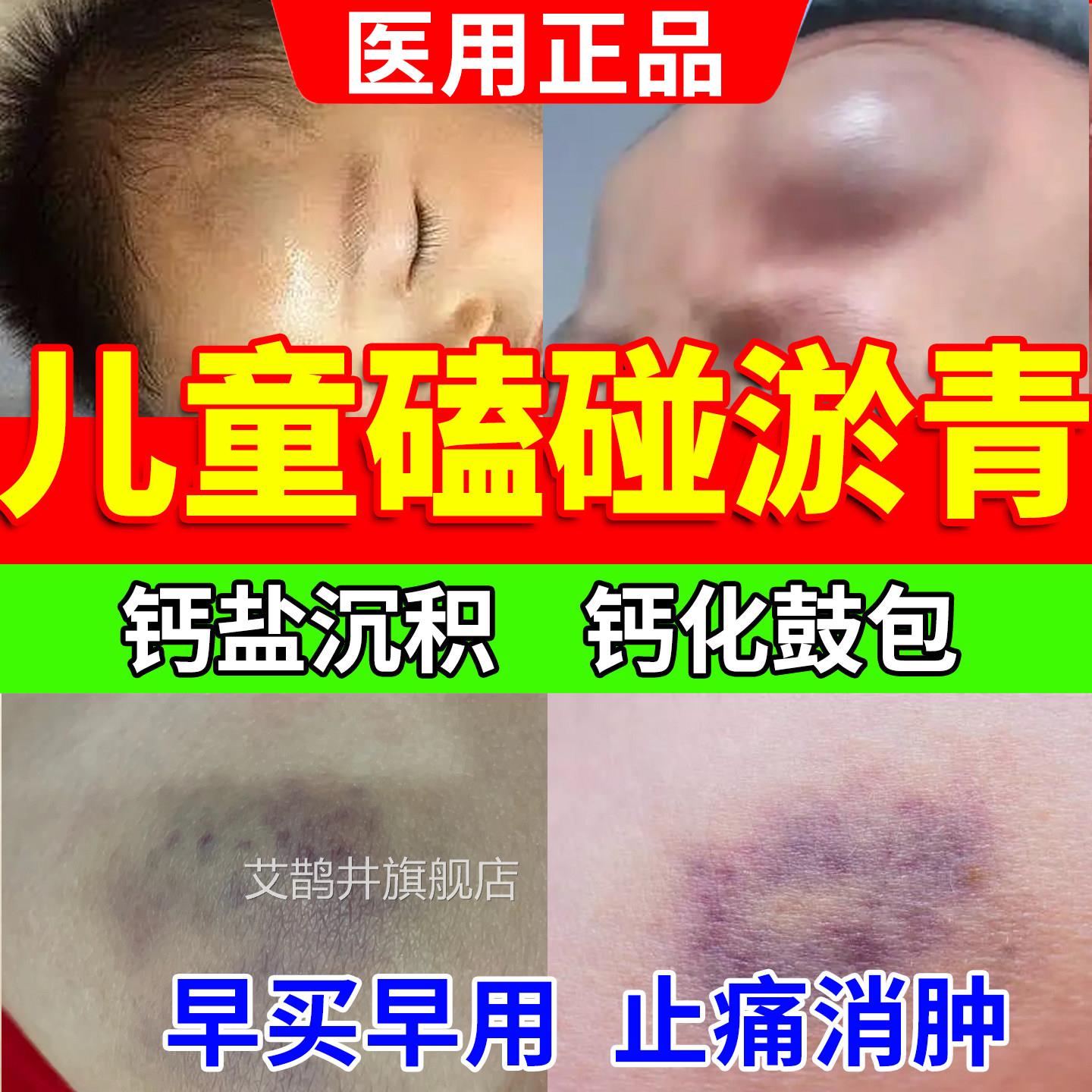 儿童宝宝淤磕青膏碰摔伤跌打损伤活血化瘀舒筋快速消肿止痛外用u9