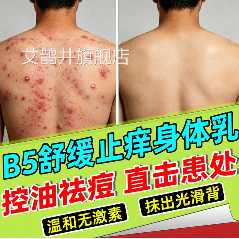 马拉色菌前胸后背部祛痘过氧化苯印甲酰身体乳粉末黑涂抹身体乳膏