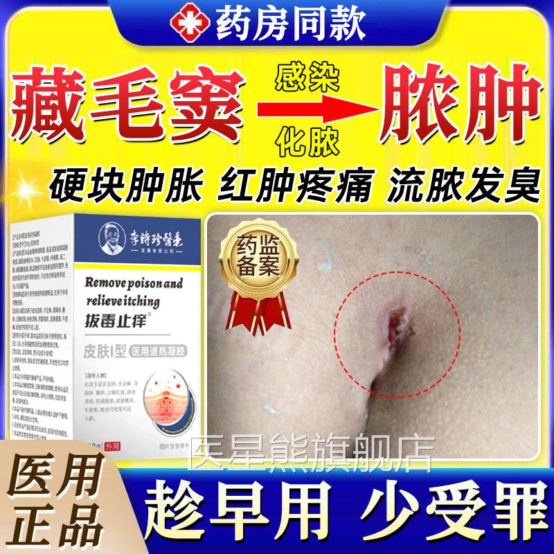 藏毛窦药膏感染化脓脓肿囊肿骶骨尾肛门疙瘩坐疮毛囊炎拔硬毒拔GX