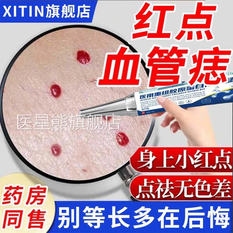 祛除红点血管痣樱桃状血管瘤蜘蛛痣疣点痣祛血瘩痣黑疙无痕凝胶ZT