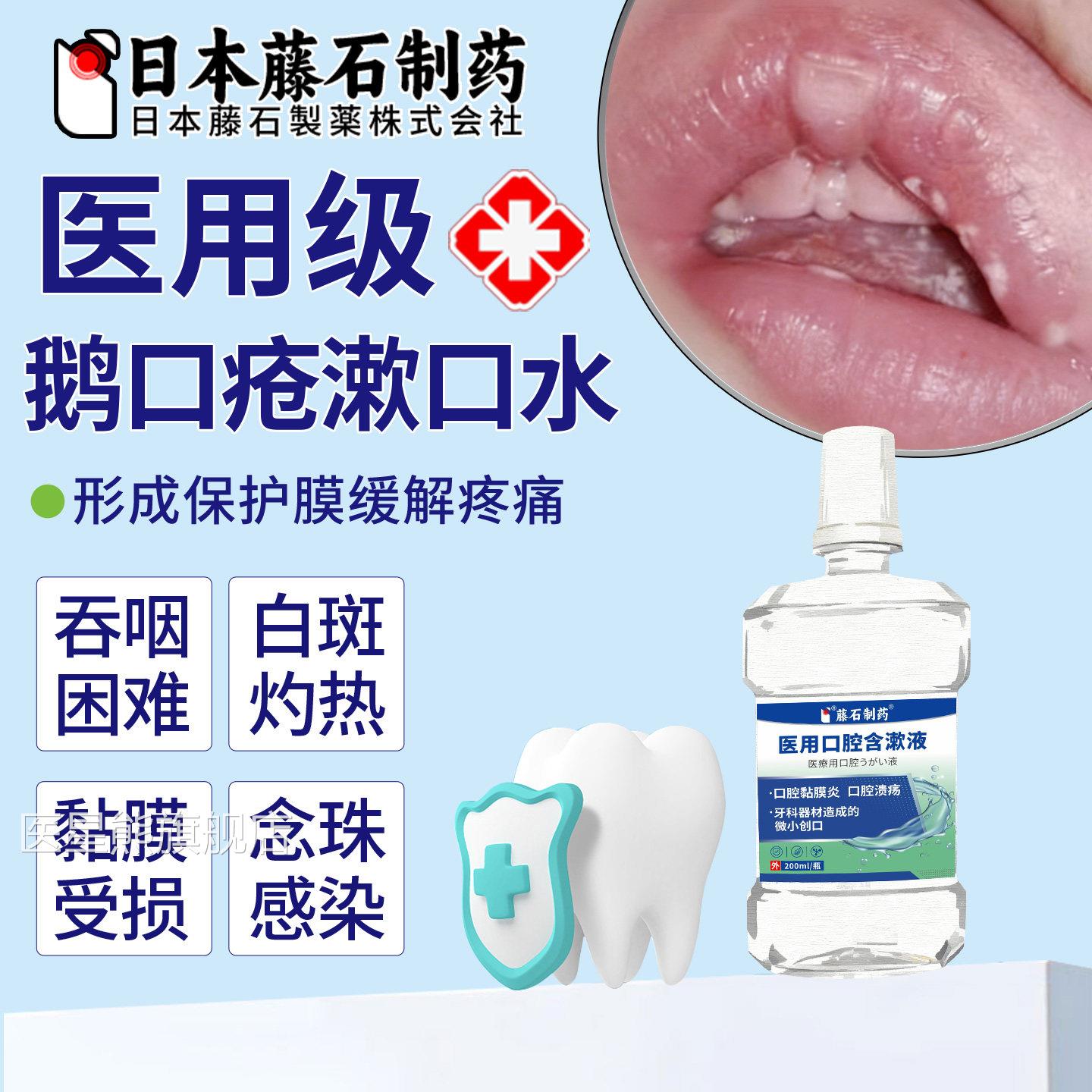 鹅口疮专用漱口水白素斑可搭碳酸氢钠霉菌片的混悬液药房同售OM医