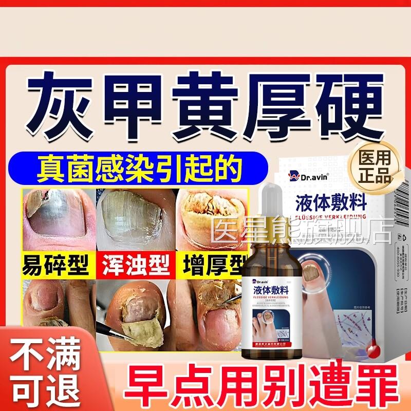 指甲脱甲膏专用抑菌液甲沟炎灰趾指灰甲脱甲精油脚指甲软化剂CA医
