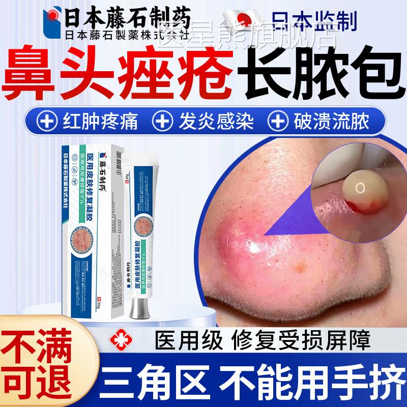 鼻子头上肉长痘痘鼻头鼻尖红肿火疖子痤疮疙瘩长脓包型药监备案OM