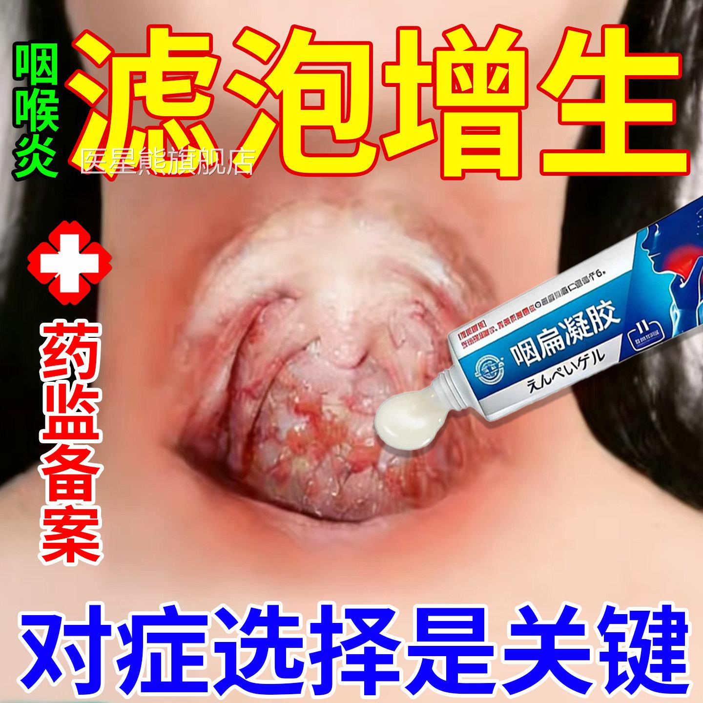 治疗性咽喉炎慢咽炎根专除用异物感咳嗽嗓子有痰喉咙滤泡增生淋巴