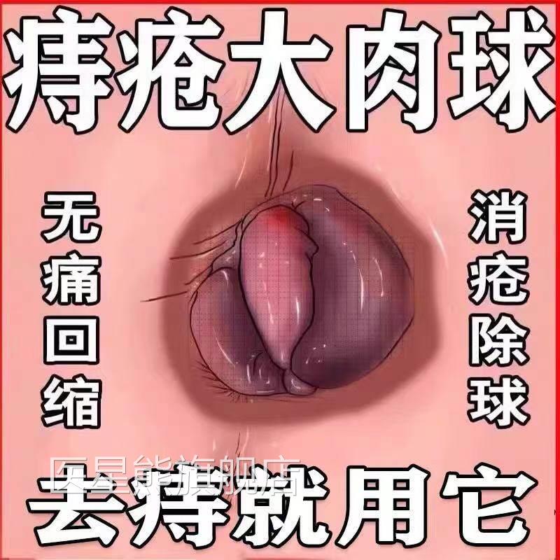修正卡波姆痔痣疮凝胶官G方正品药膏排行榜名痔断去肉球神器X医星