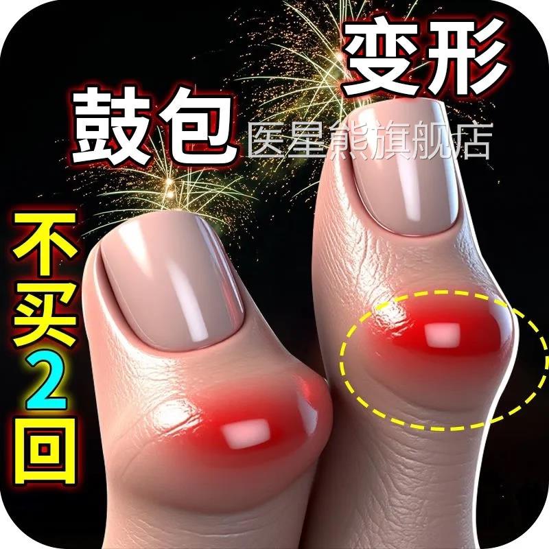 手指骨关炎专用膏药变形肿大僵硬节疼理疗热敷内风湿类关节痛贴膏