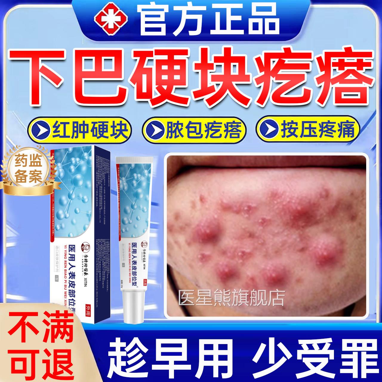 下巴反复长痘硬块修复膏内分泌失调痘痘肿红疼结节脓包痤疮囊肿UU