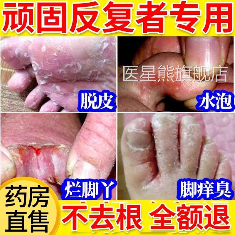 云护南本草喷雾去除臭脚气止痒水泡脱皮杀菌喷剂可专搭用理医星熊