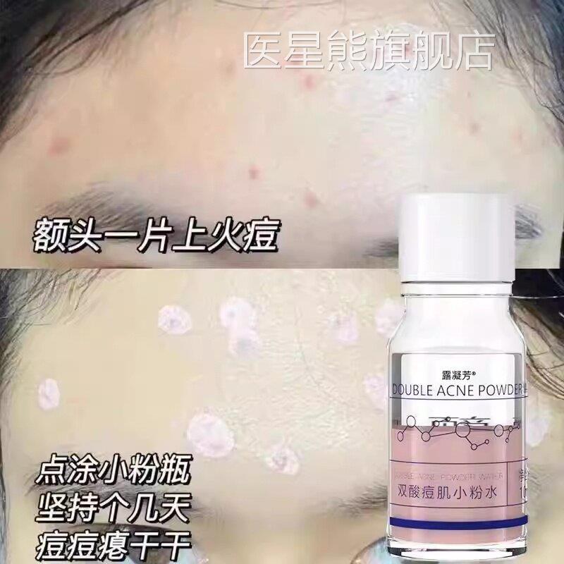 双酸痘肌痘小粉水祛痘小粉瓶水杨酸精华液果酸印痘坑修淡化痘疤复