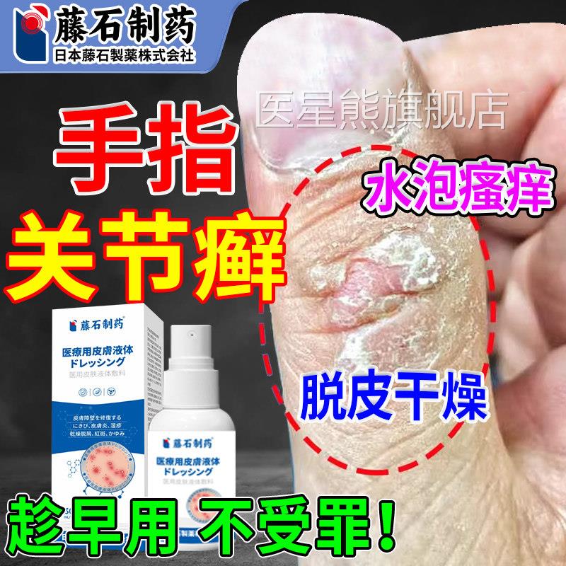 手癣膏脱皮掌干 干裂真菌感染手指关节癣搭配膏药贴硬疙瘩手鹅风O