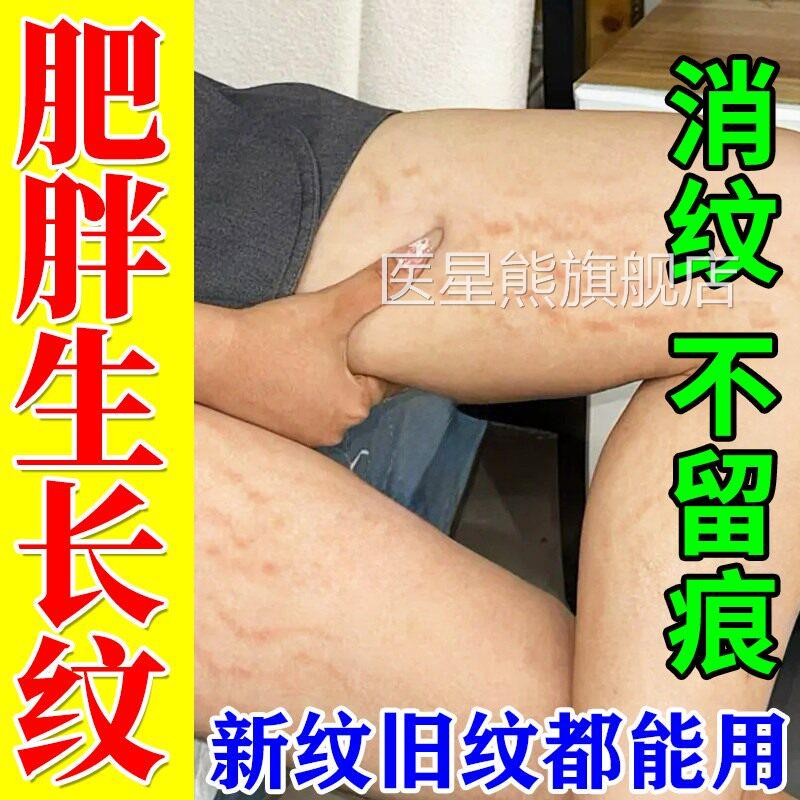 去除肥胖纹青少年专用学生消除大腿生长肚纹修复霜紧致皮去妊娠纹
