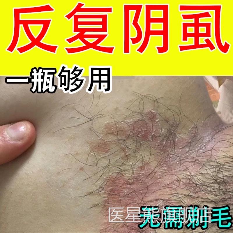 男性阴瘙痒止痒抑菌消非炎百步酊灭阴毛虱专用药男士私处官方正品