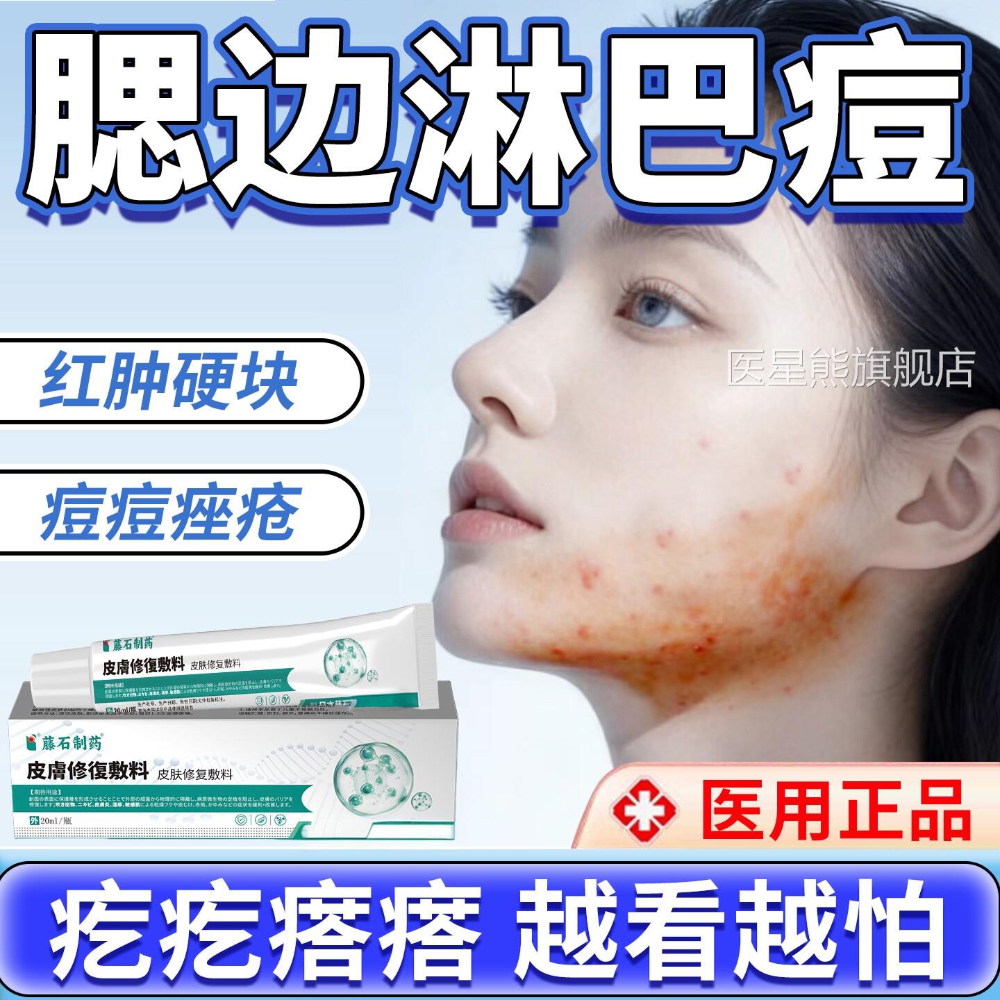 淋巴痘腮边痘下巴反复长痘专用痤疮膏肿红硬块痘痘药房同售调理CA