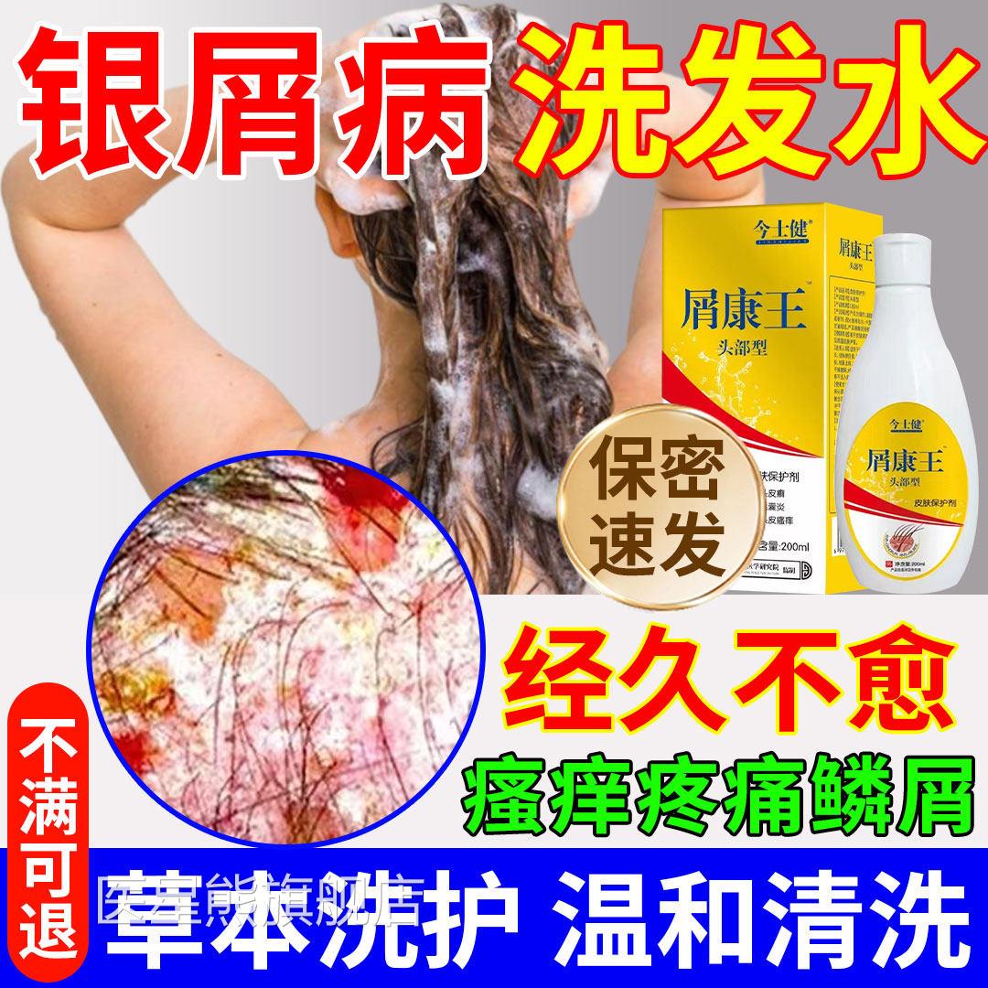 头皮银屑专用洗发病水可搭配牛皮癣生物制剂膏脂溢性皮炎js医星熊