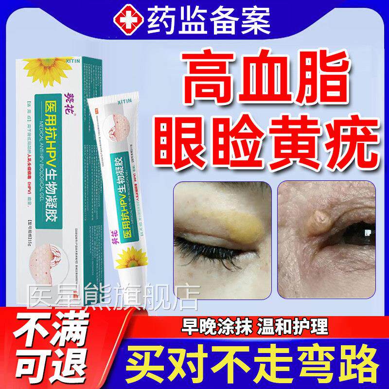 眼睑黄瘤去眼除皮黄斑瘤黄疣专用膏眼部脂肪粒睑黄疣眼角黄斑去UU