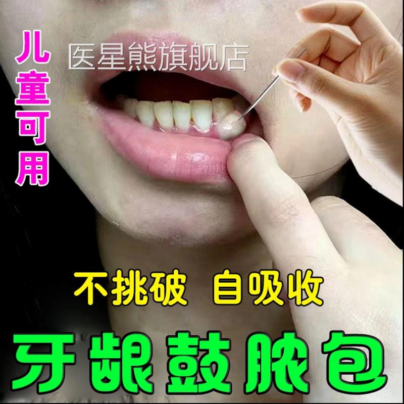 包牙龈脓包肿包肿痛发炎起包辅助牙根上火牙髓炎牙根瘘管鼓喷雾剂